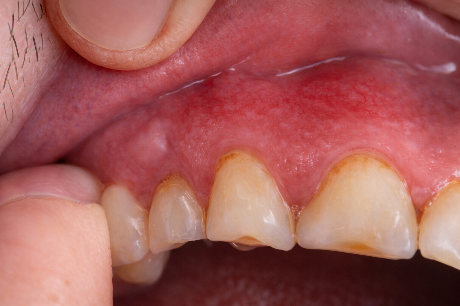 Dental Abscess