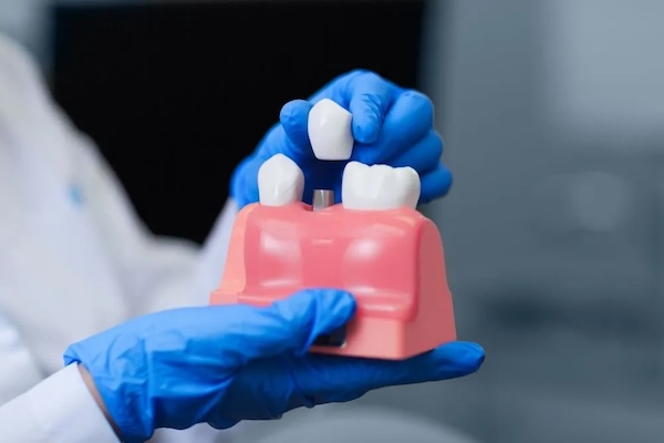 Dental Implant Maintenance