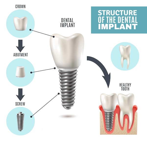 Dental Implants