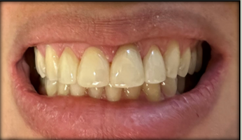 After Anterior Upper Crowns