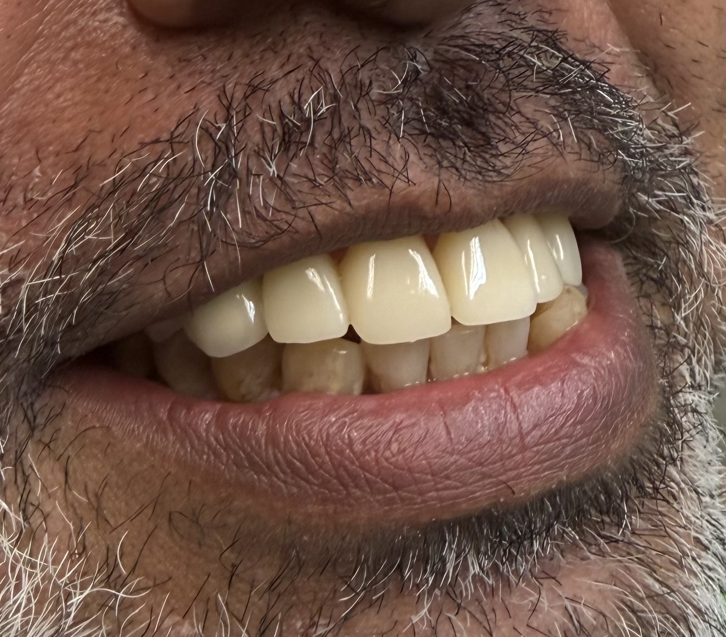 After Complete Maxillary Reconstruction