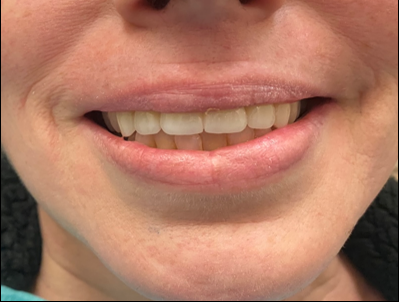 After Fixed Partial Denture Bridge