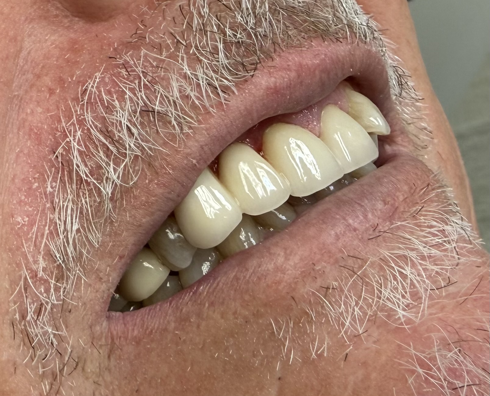 After Upper Fixed Partial Denture Bridge