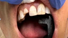 Before Fixed Partial Denture Bridge