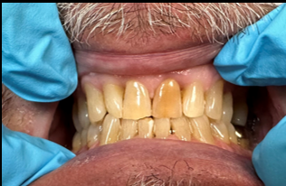 Before Anterior Upper Crowns