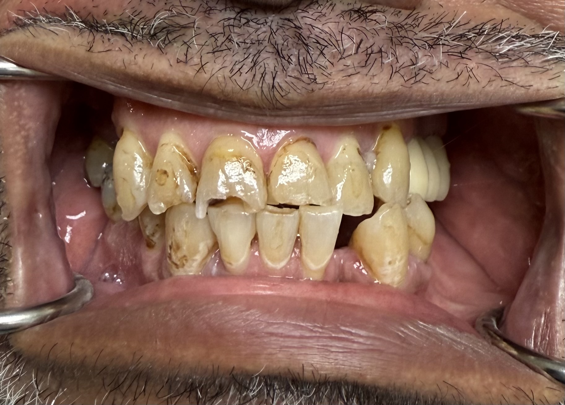 Before Complete Maxillary Reconstruction