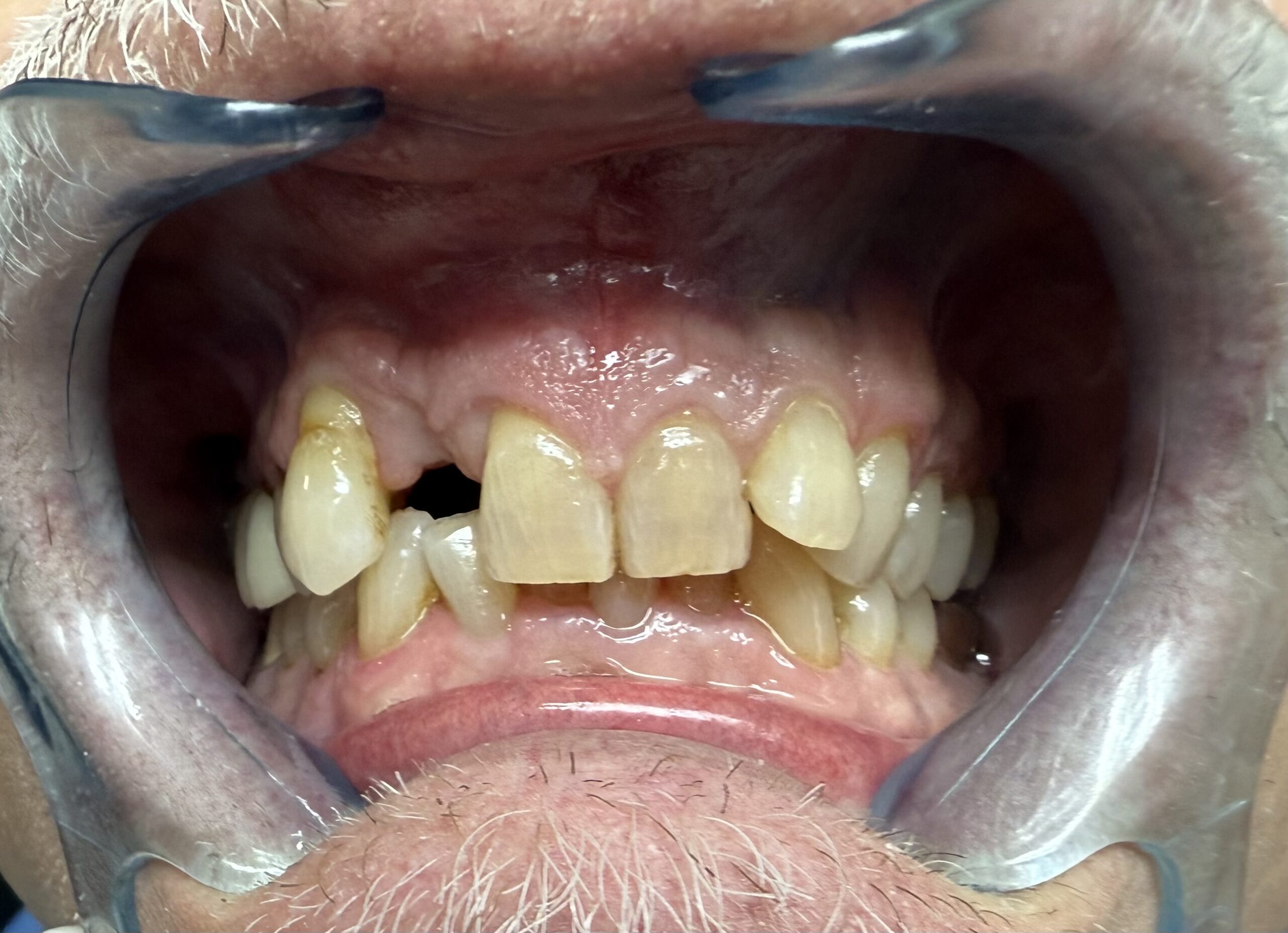 Before Upper Fixed Partial Denture Bridge