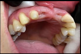 Before Fixed Partial Denture Bridge
