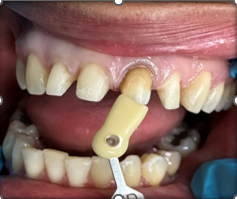 Before Anterior Upper Crowns