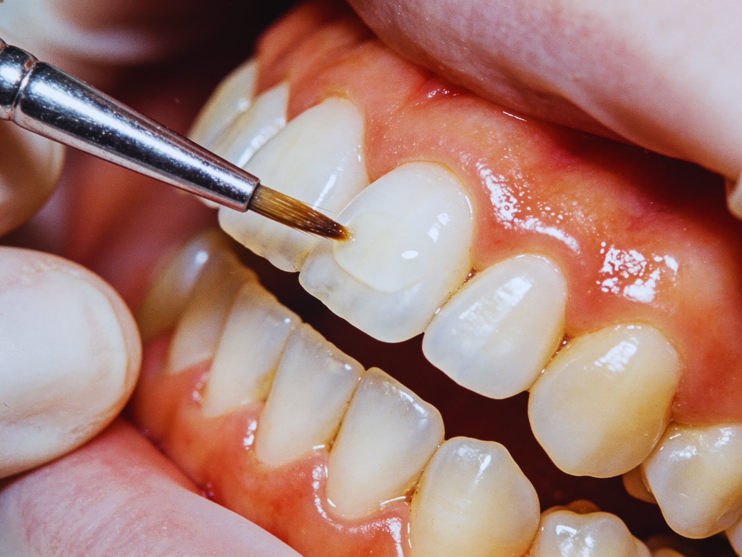 Smile makeover planning and results