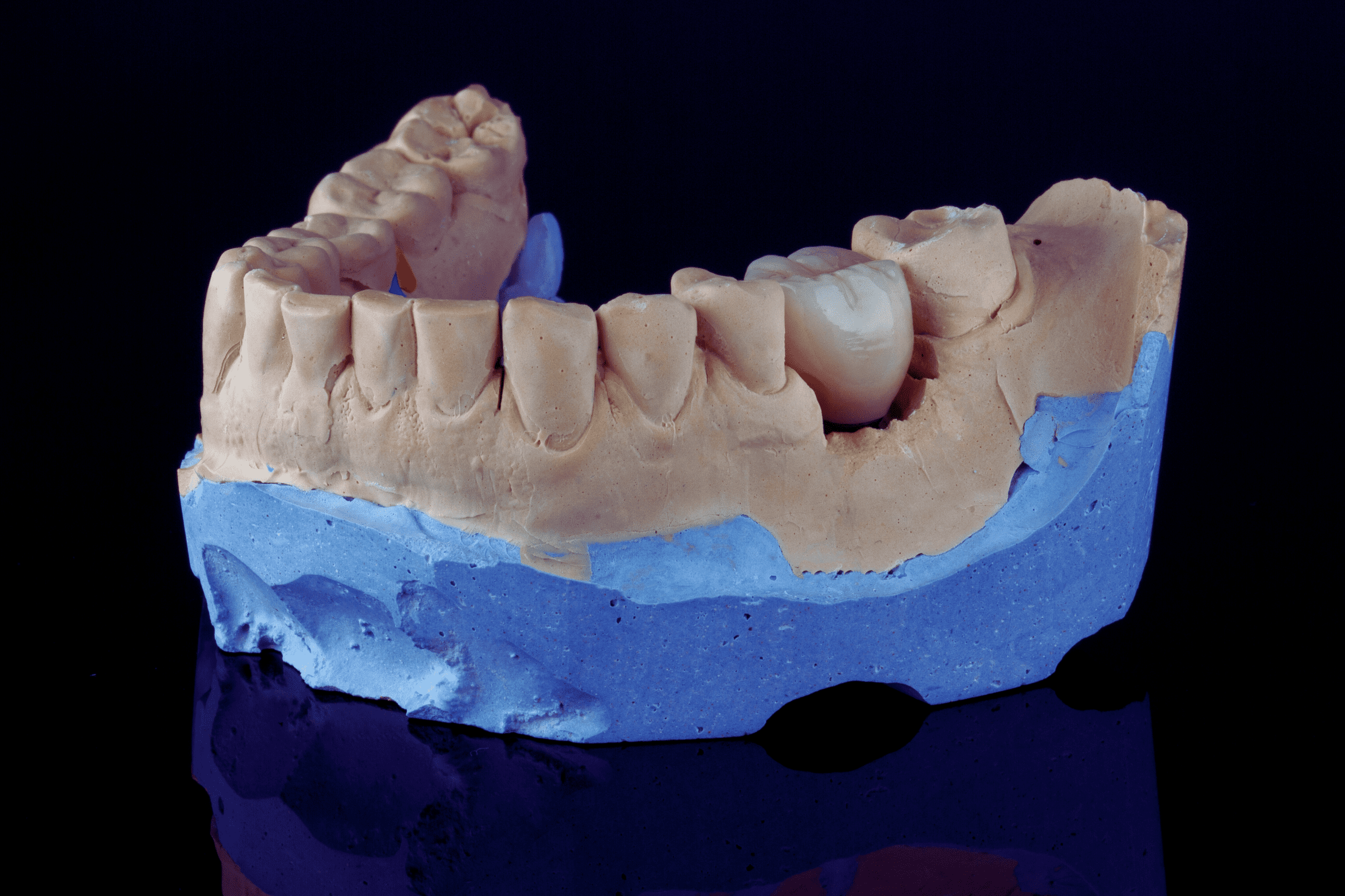 Dental crown restoration