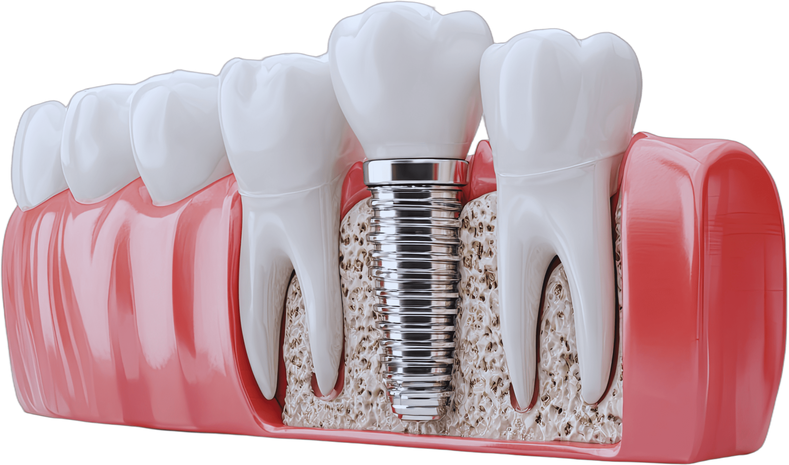 Dental implant planning and imaging