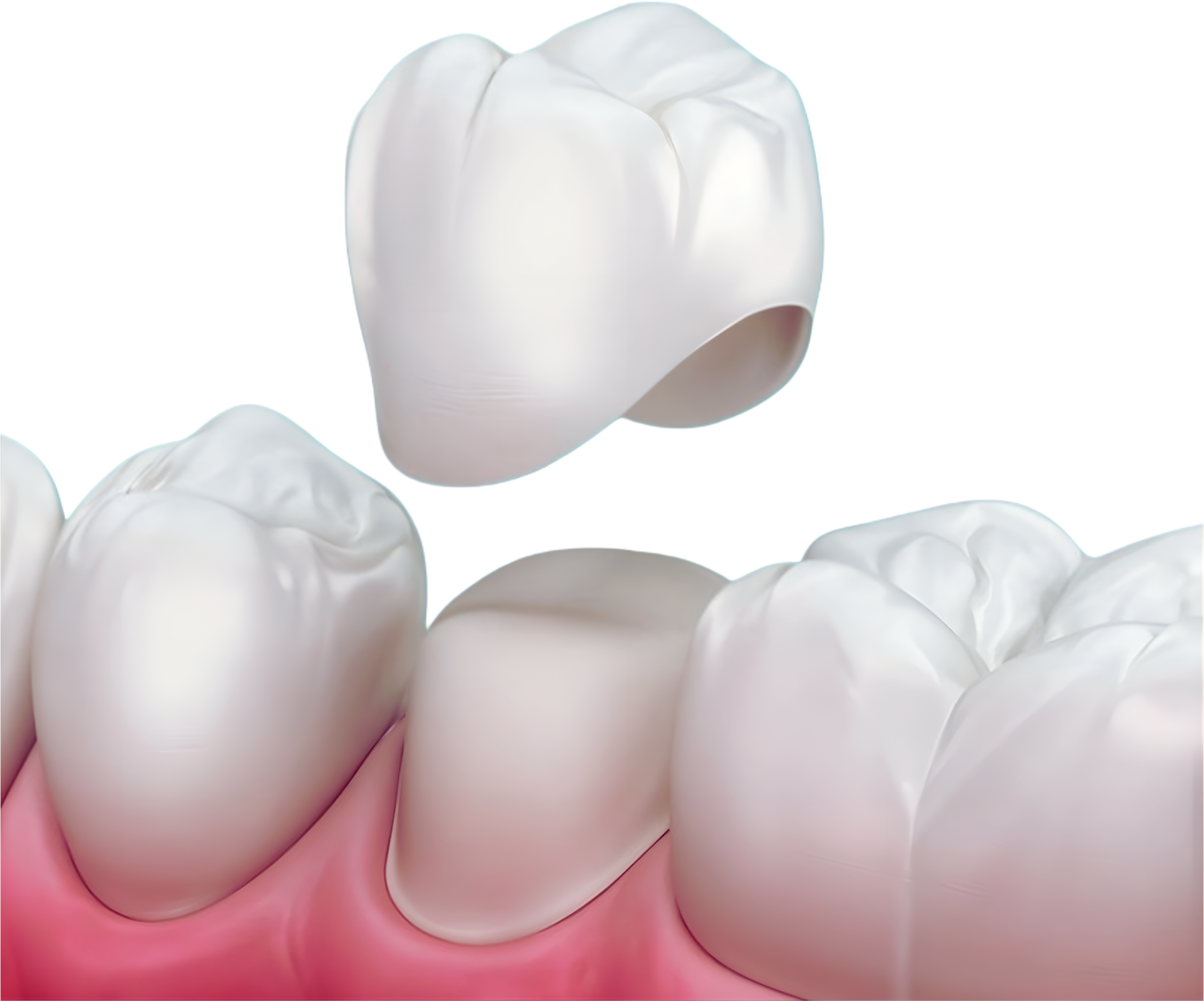 Dental crown options and treatment planning