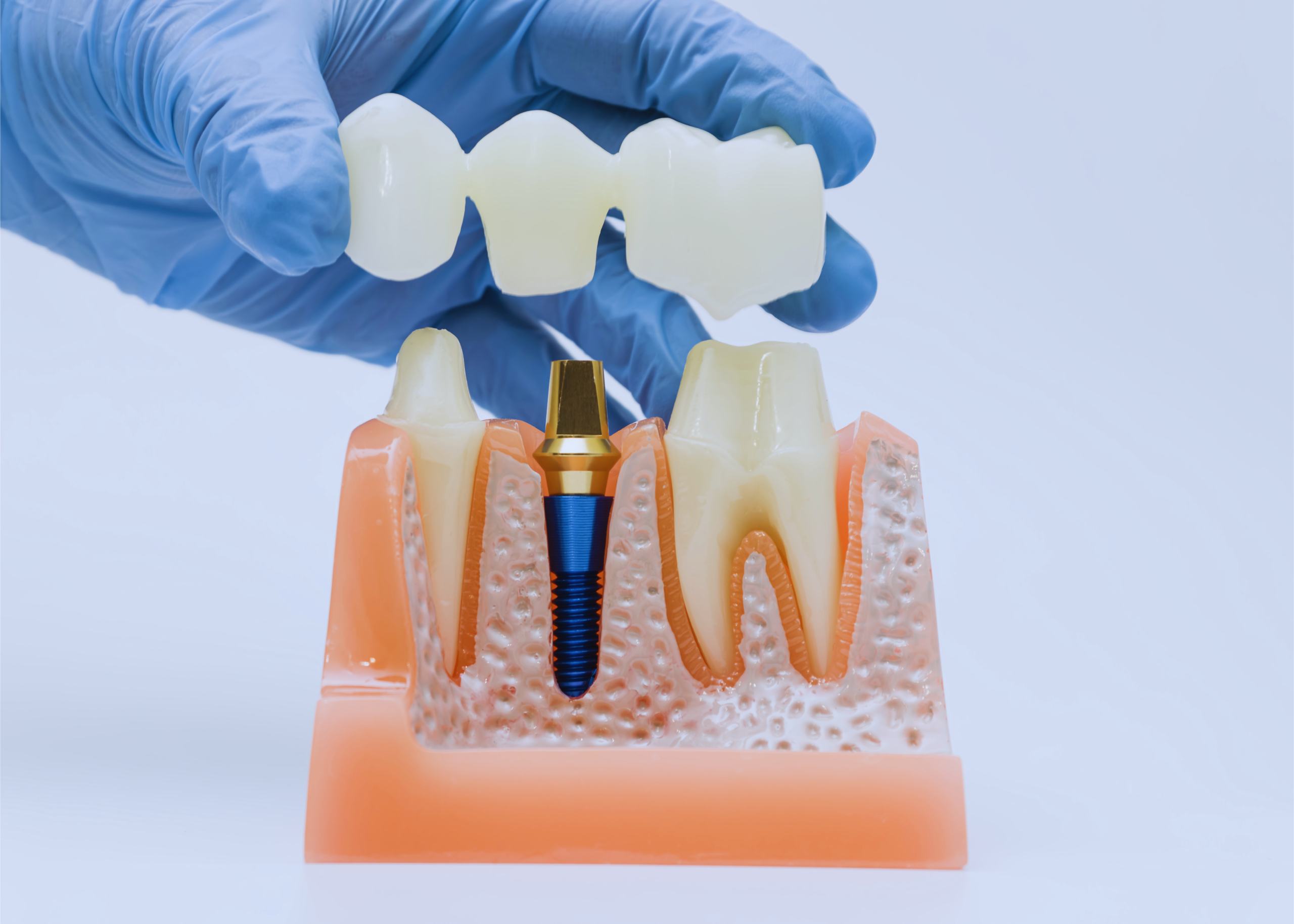 Natural-looking dental crowns for front teeth