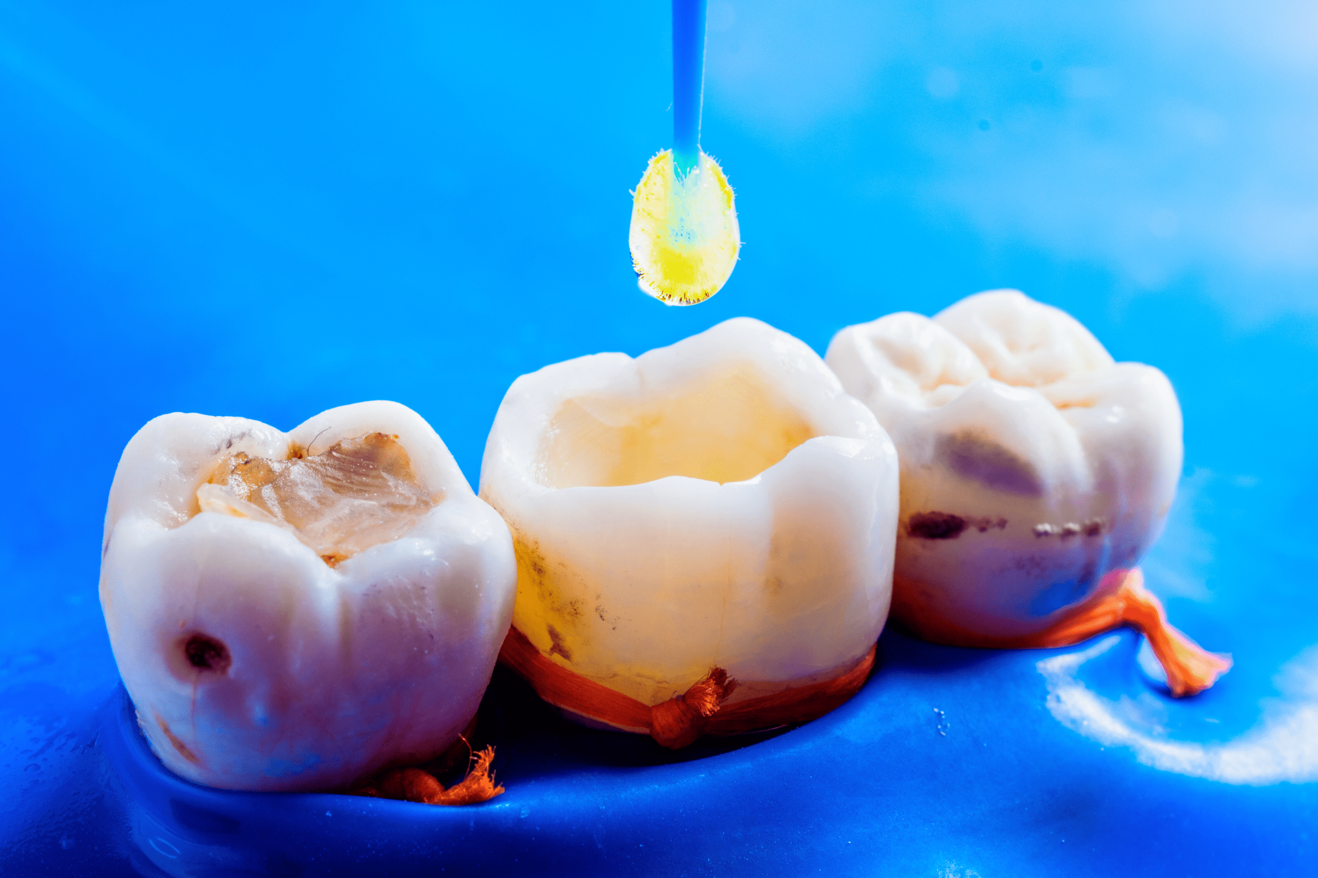 Dental filling treatment at Diamond Dental Arts