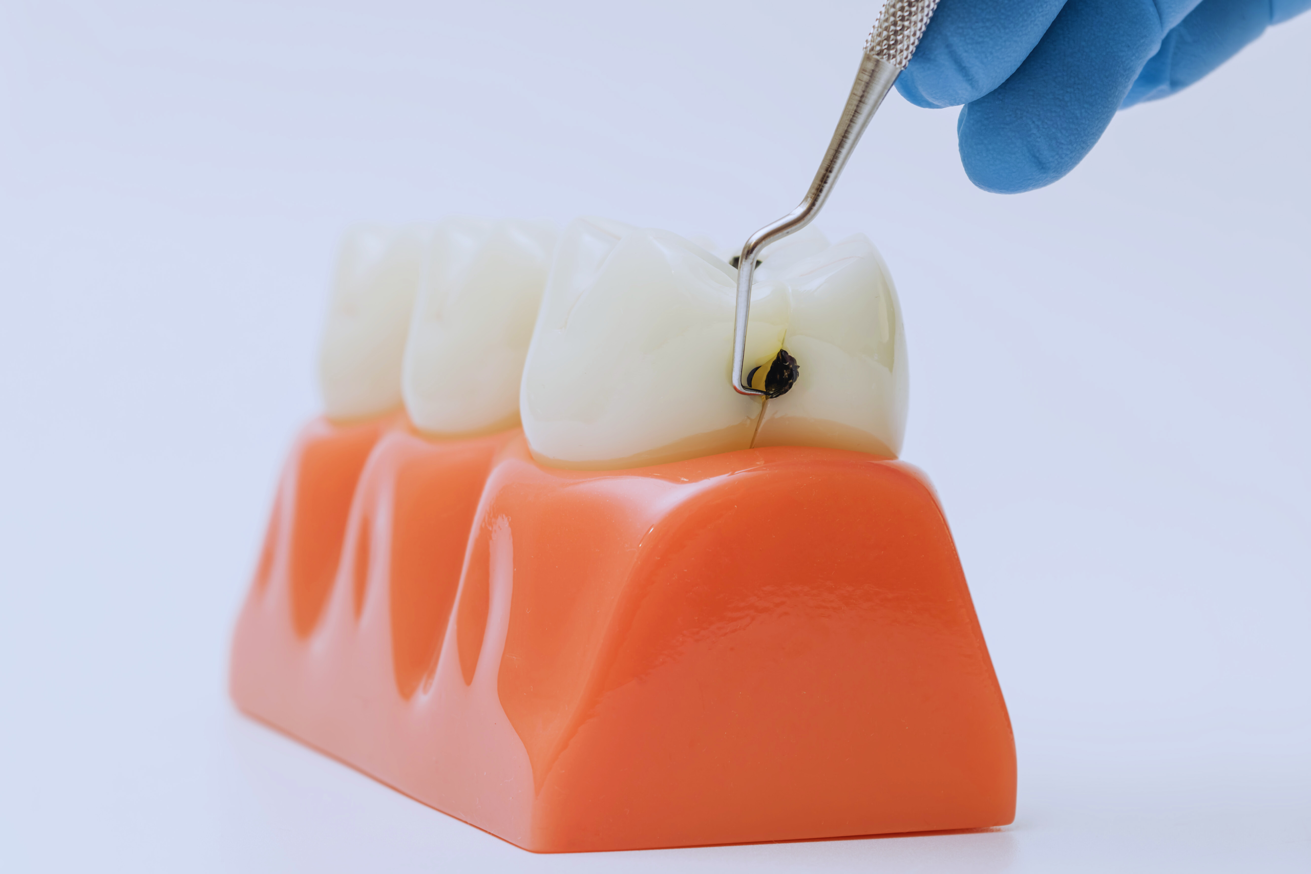 Dental bonding to repair chips and cavities