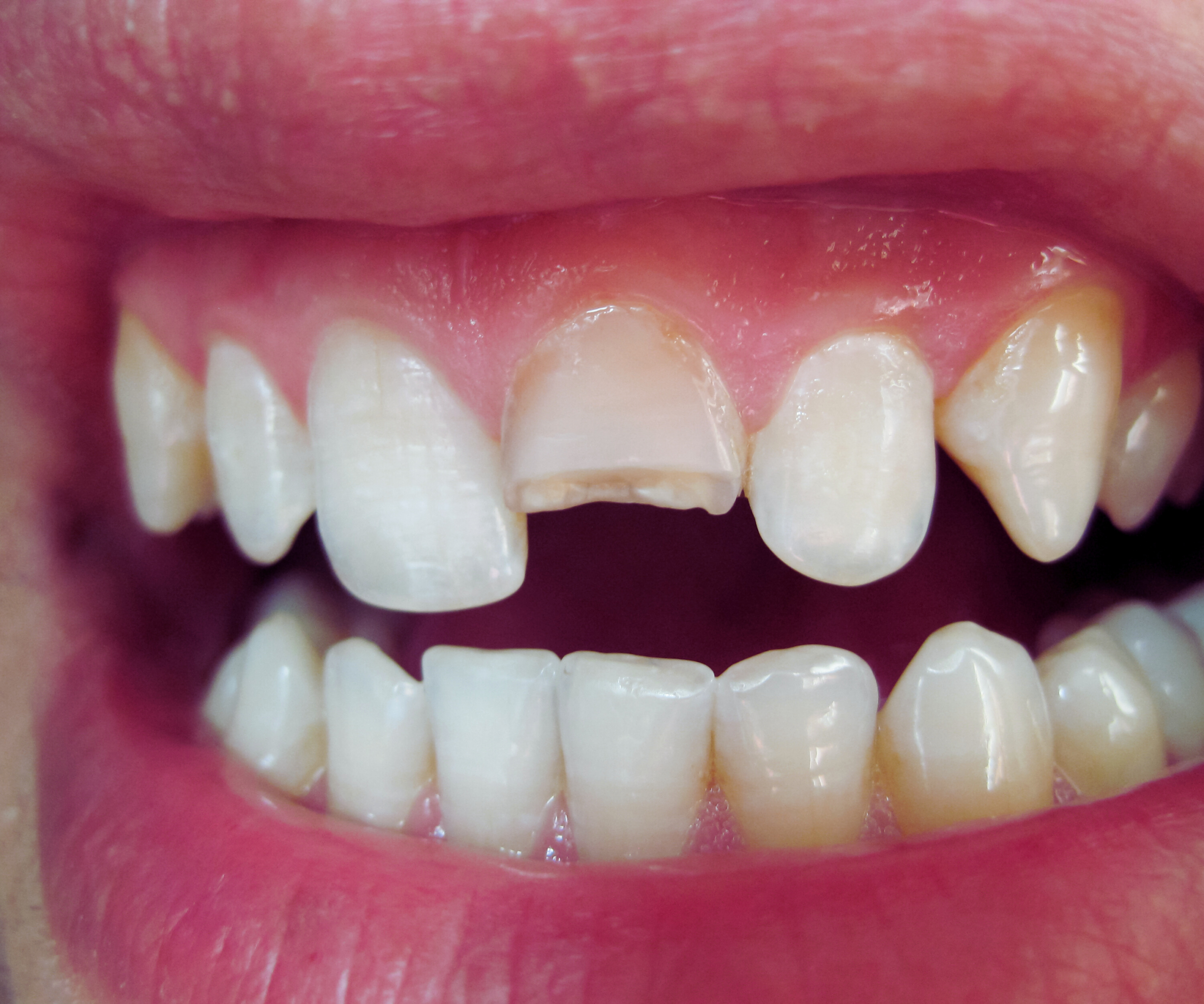 Tooth-colored bonding results and natural appearance