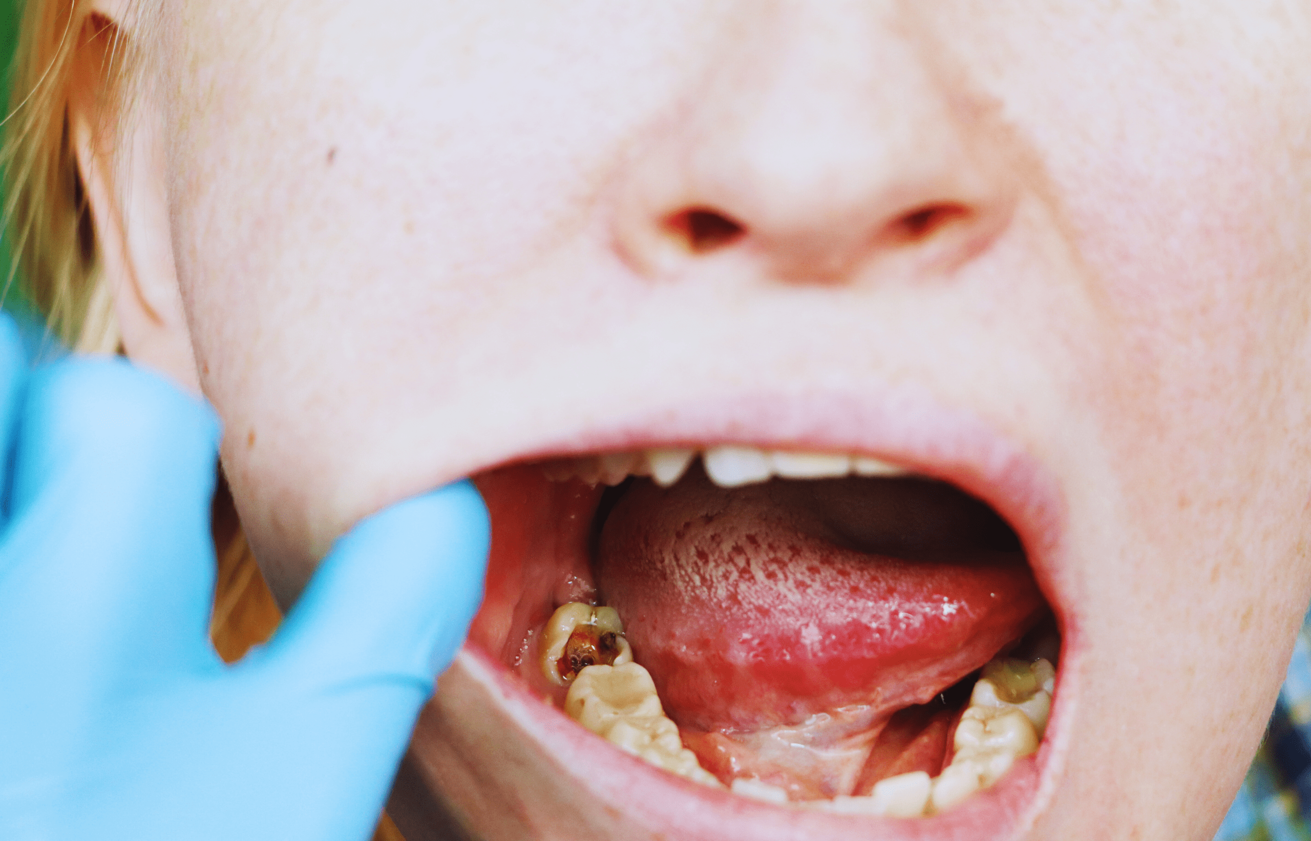 Dental exam and cavity detection