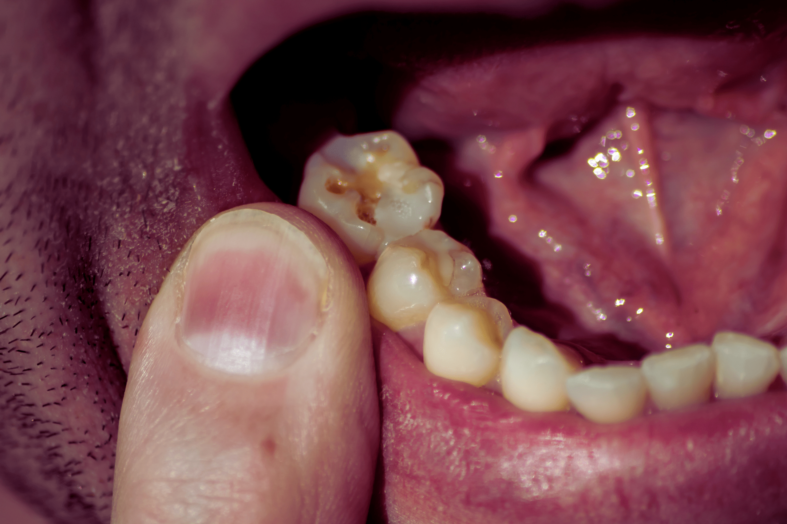 Cavity prevention and oral hygiene