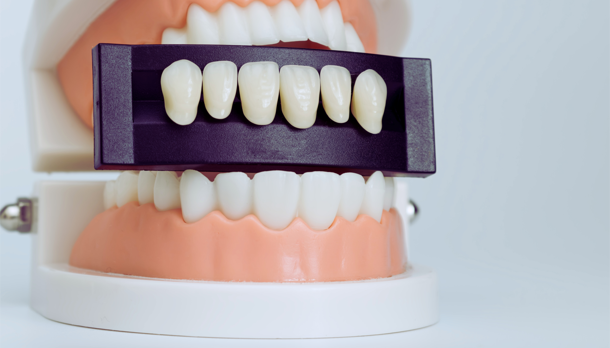 Caring for veneers and long-term smile results