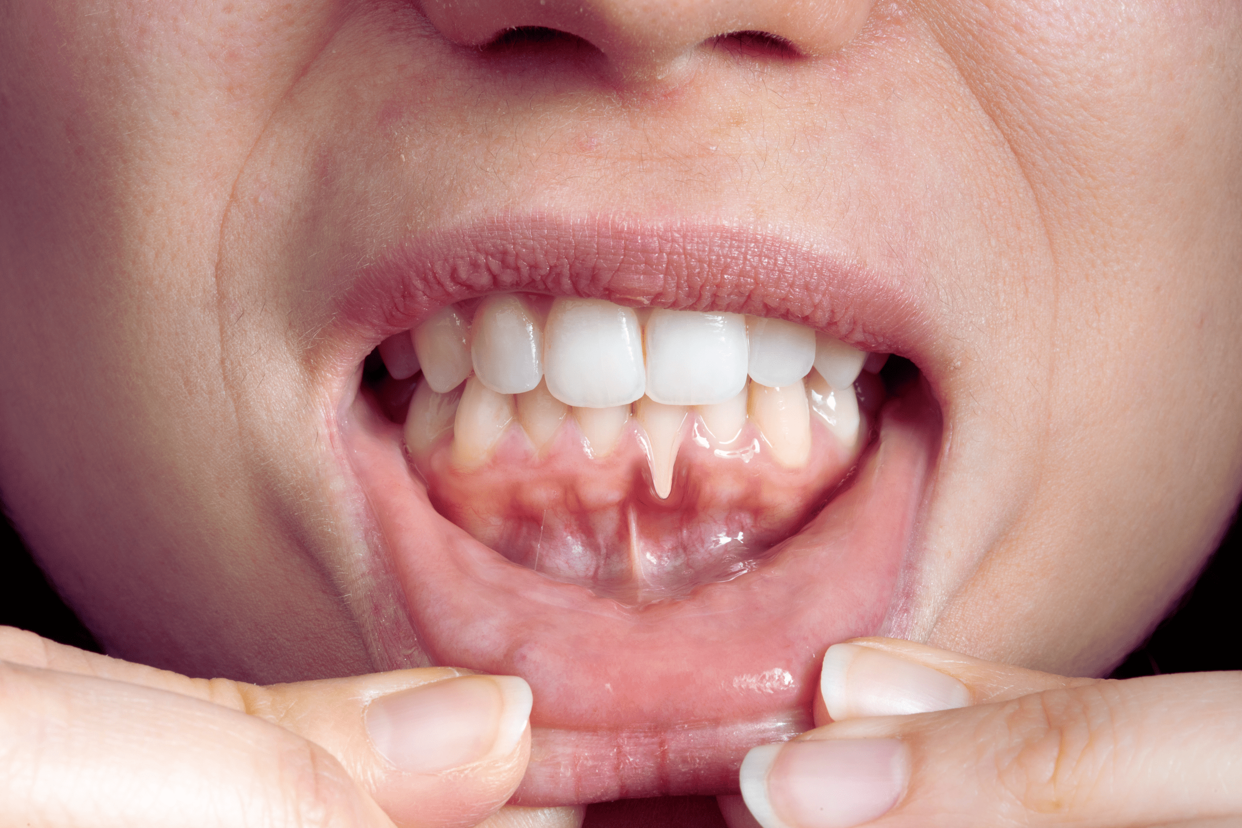 Gingivitis signs and gum inflammation