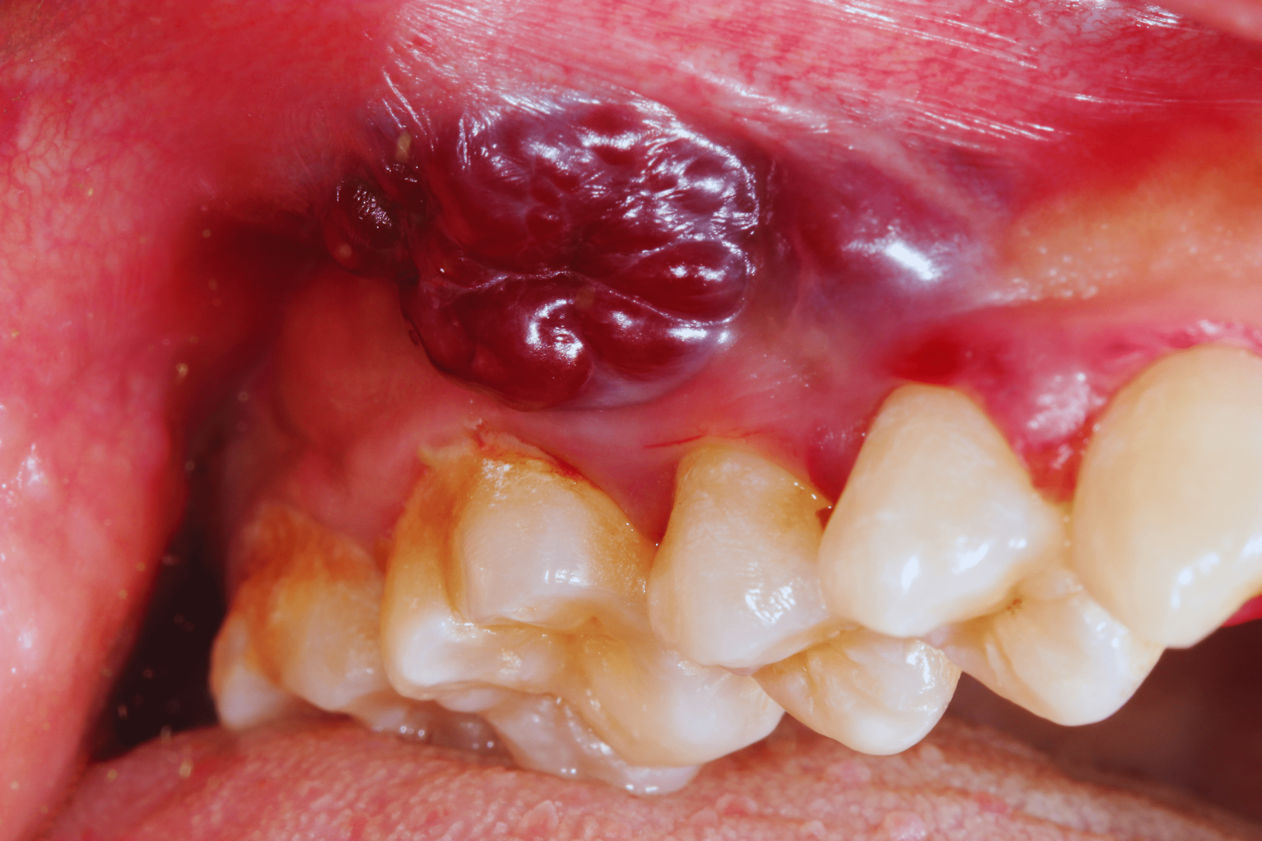 Oral cancer awareness and screening illustration