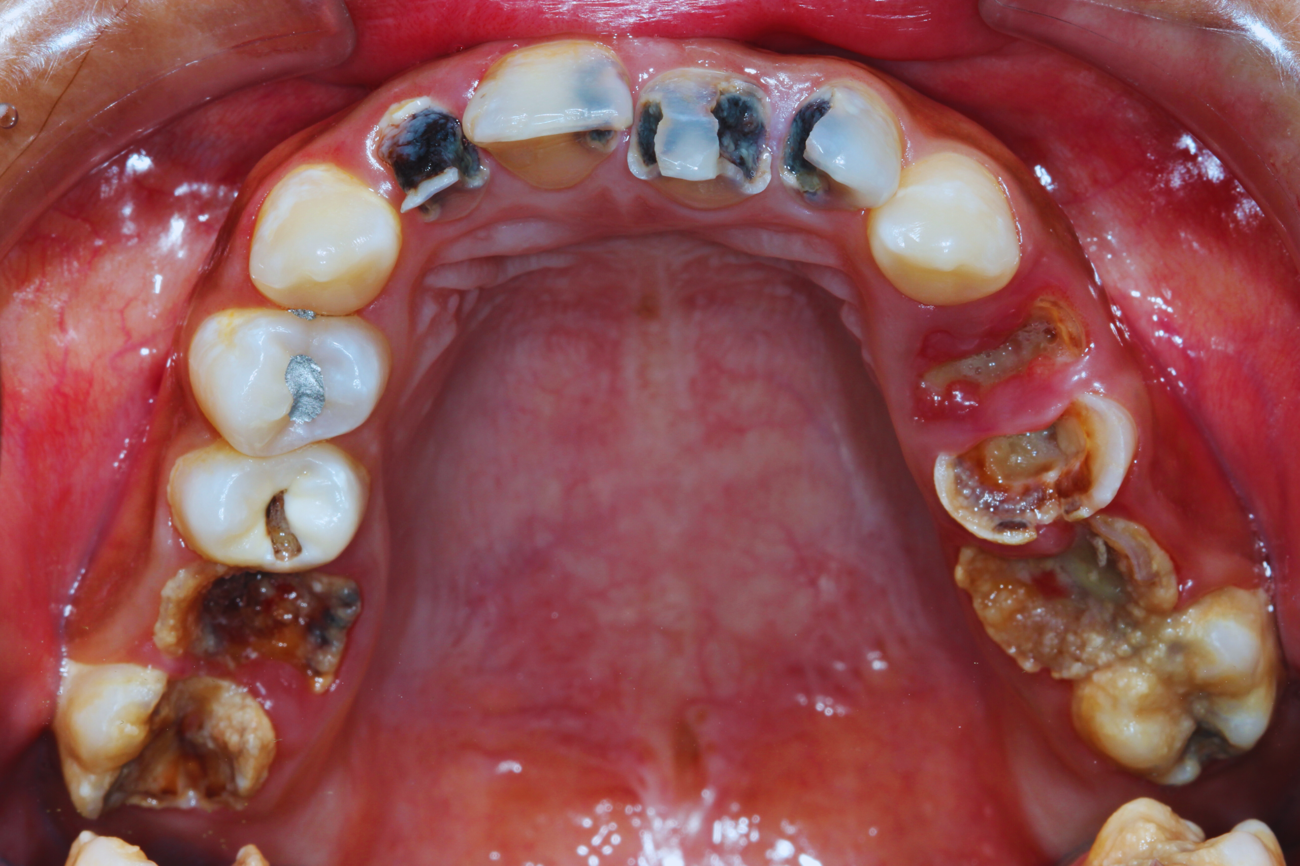 Periodontal disease and gum infection illustration