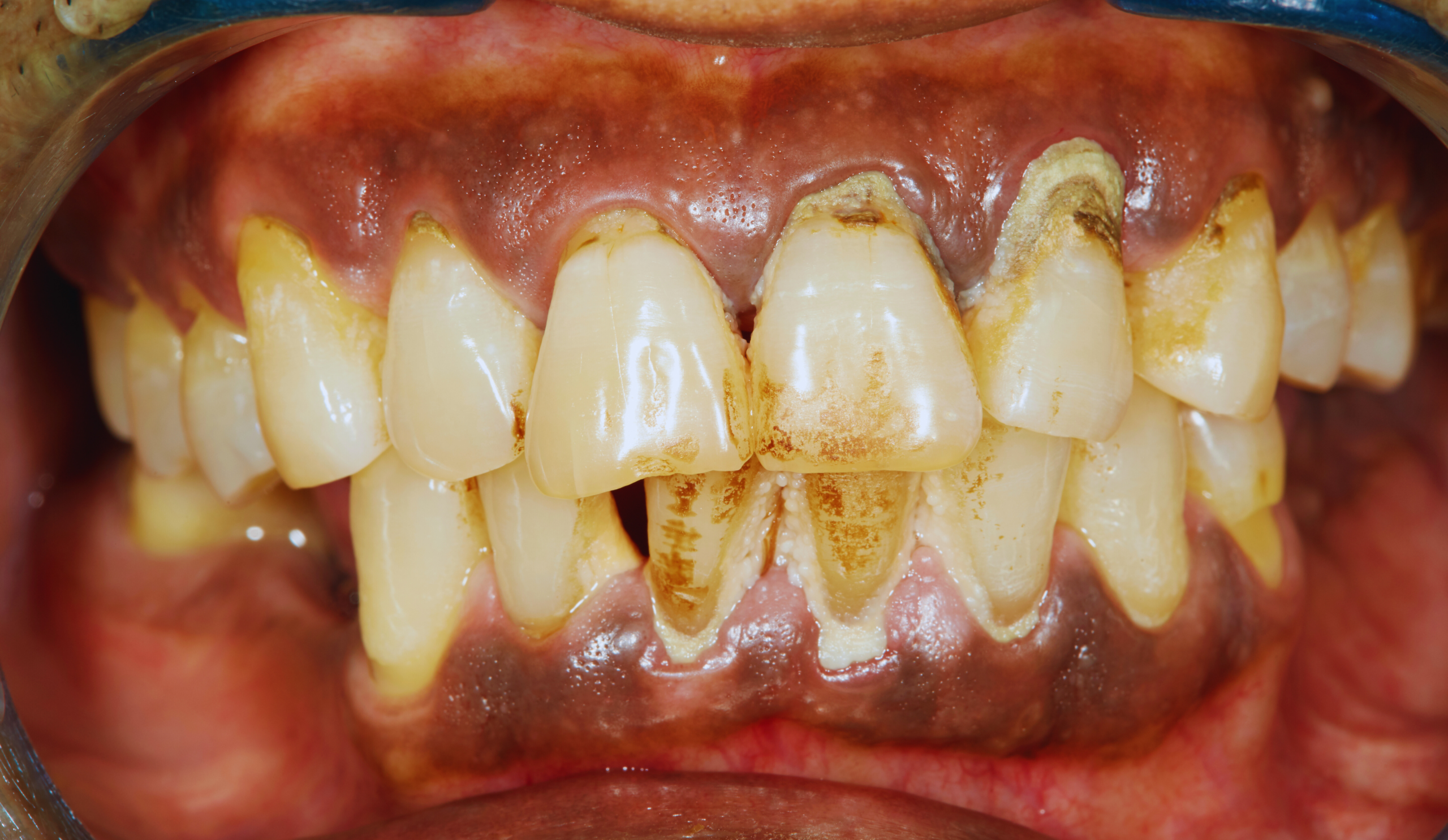 Gum disease and bone loss illustration