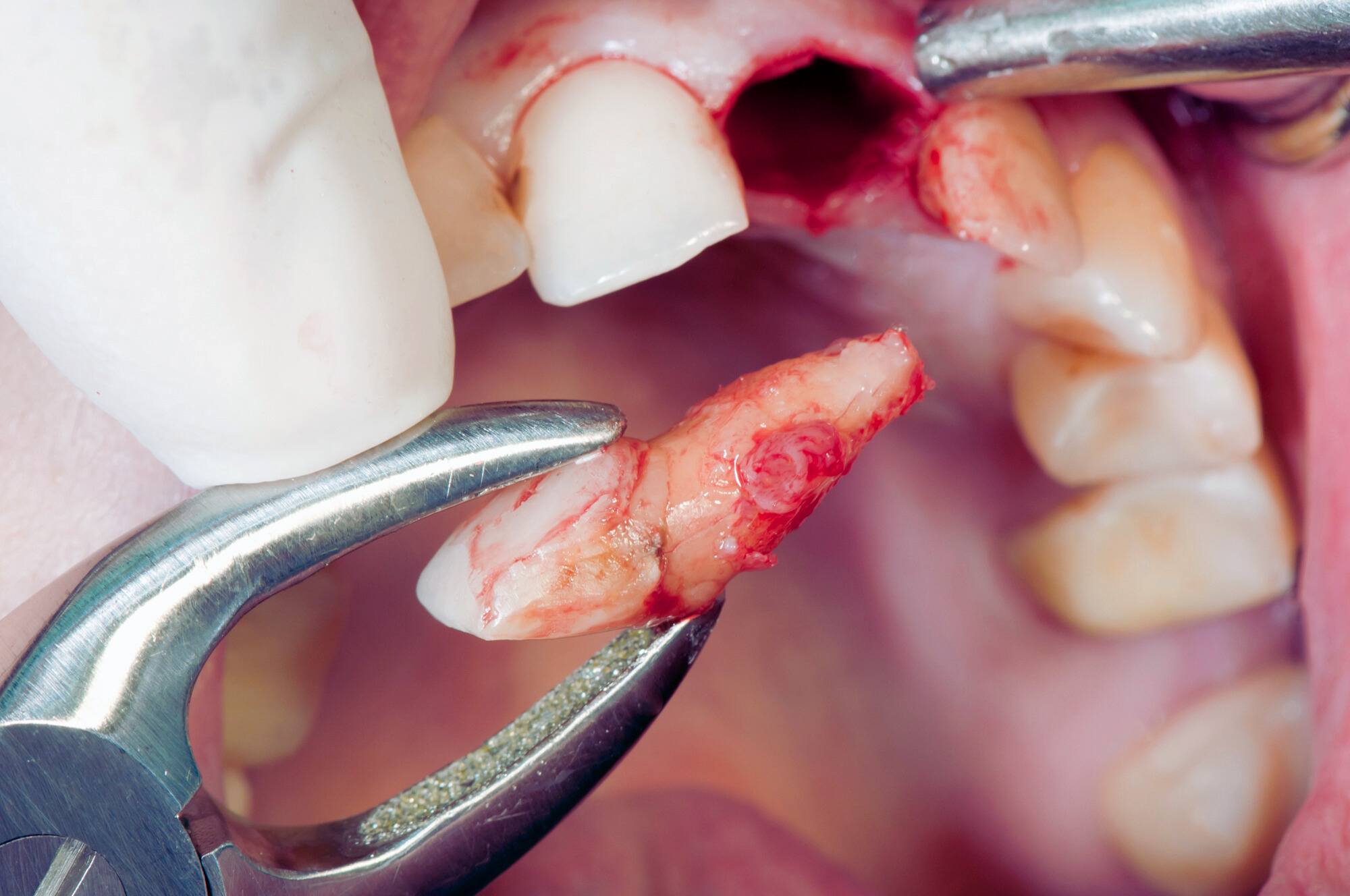 Wisdom tooth and oral surgery illustration