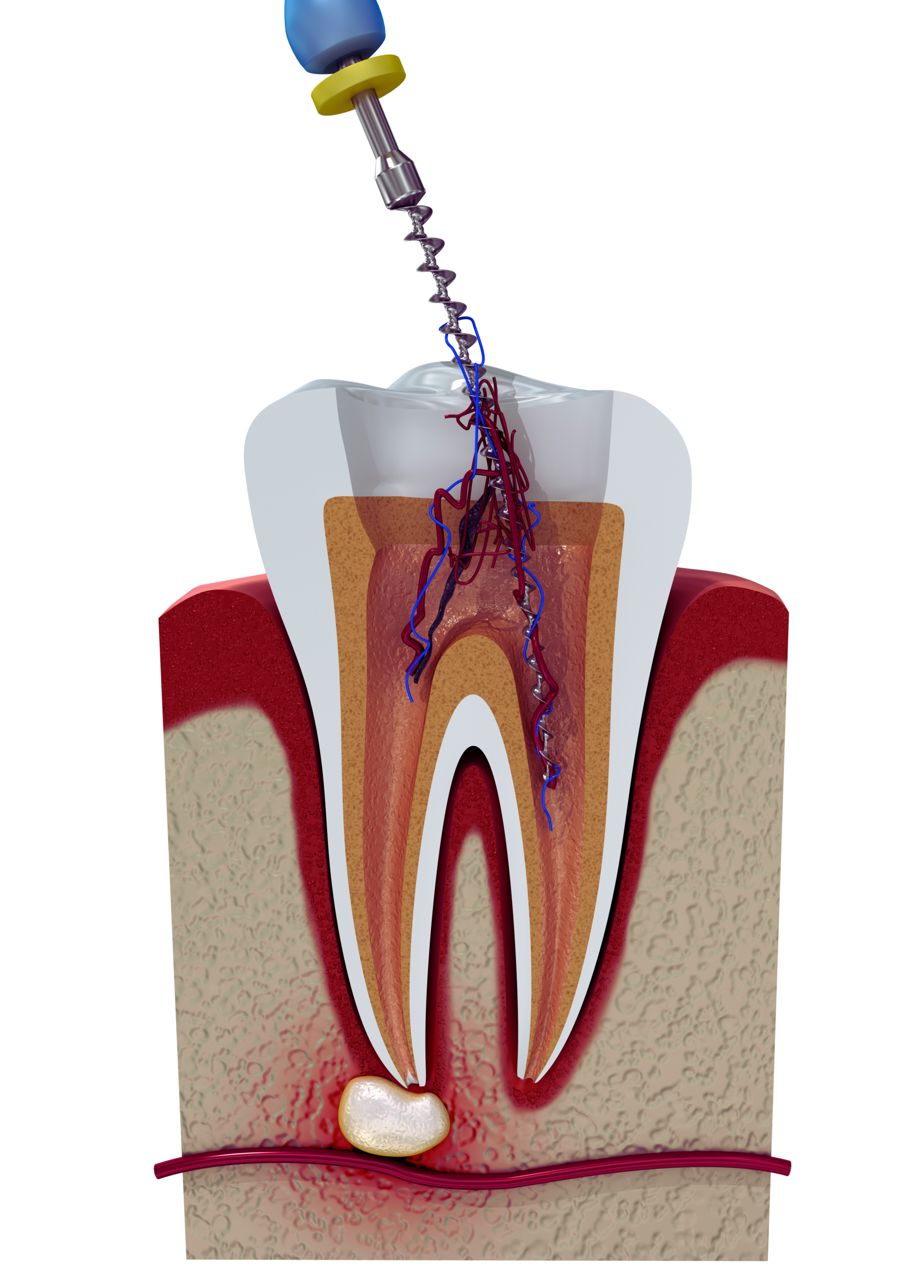 Root canal treatment helps save an infected tooth