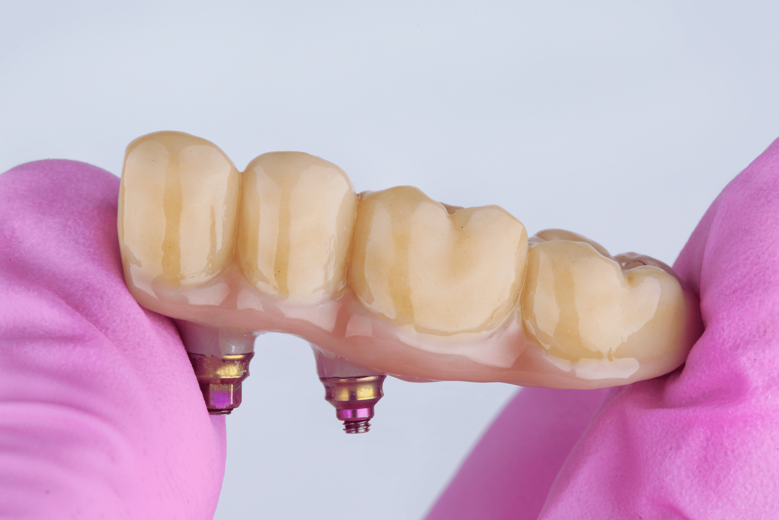 Dental bridge replacement