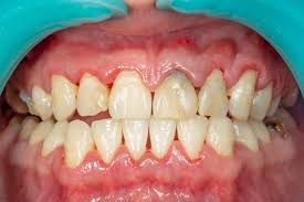 Gum recession and inflammation example