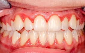 Bleeding gums and gingivitis warning signs