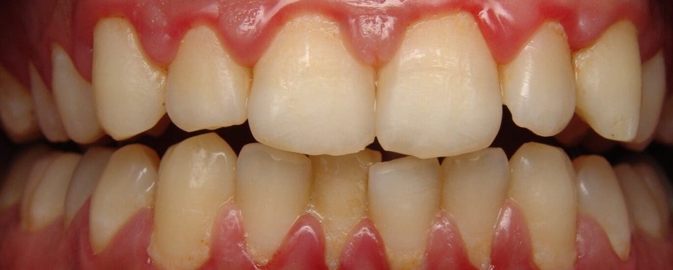 gum disease blog - Diamond Dental Arts, Punta Gorda FL