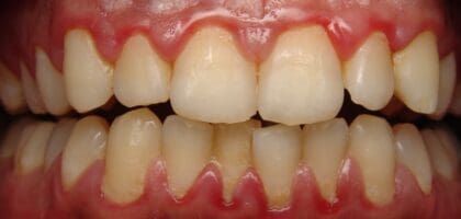 gum disease blog - Diamond Dental Arts, Punta Gorda FL
