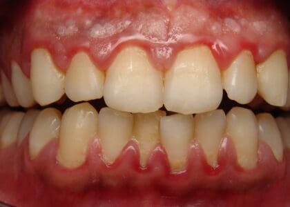 gum disease blog - Diamond Dental Arts, Punta Gorda FL