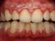 gum disease blog - Diamond Dental Arts, Punta Gorda FL