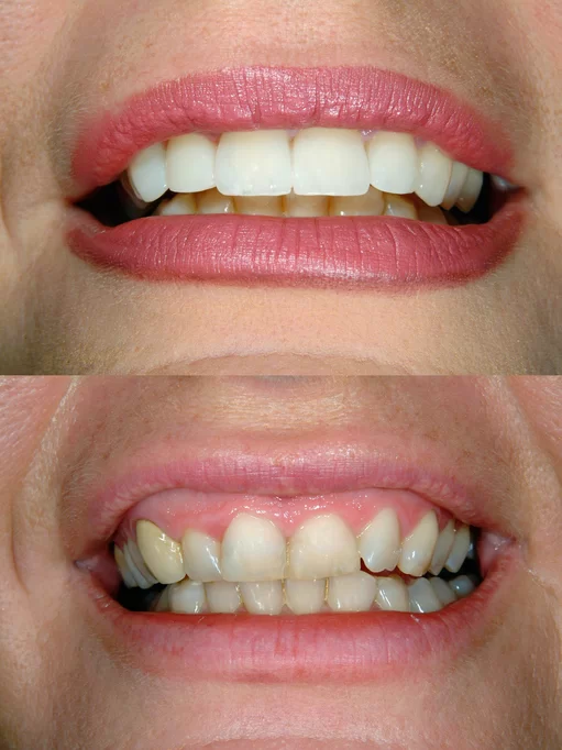 Gummy smile before and after correction