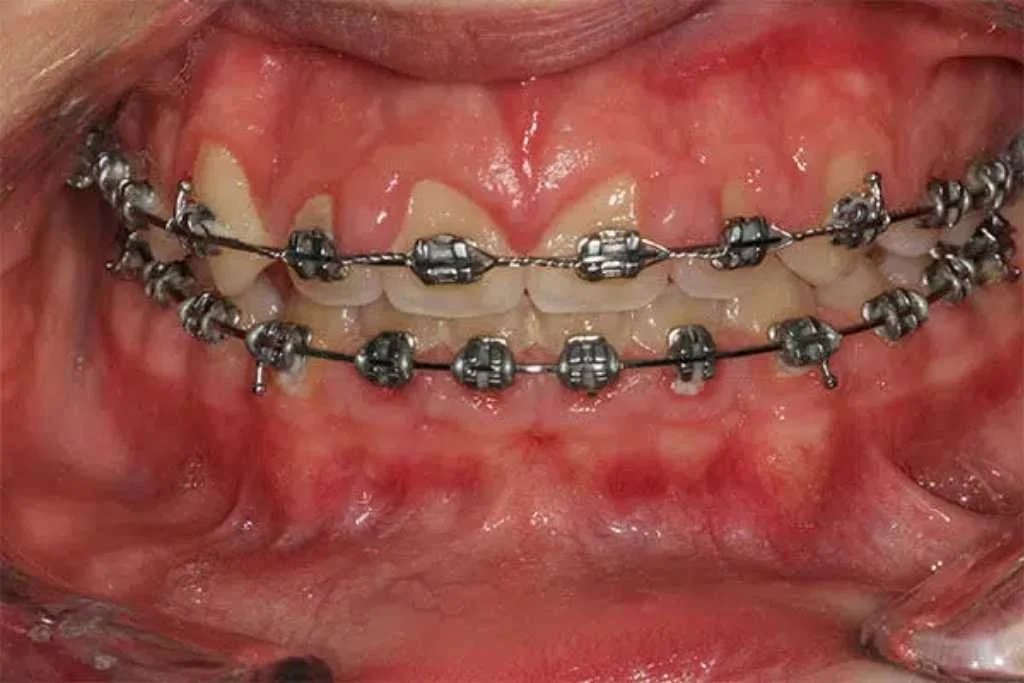 Gummy smile example before treatment