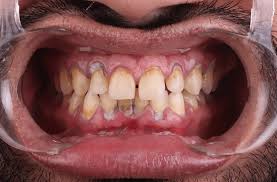 Healthy gums vs inflamed gums comparison